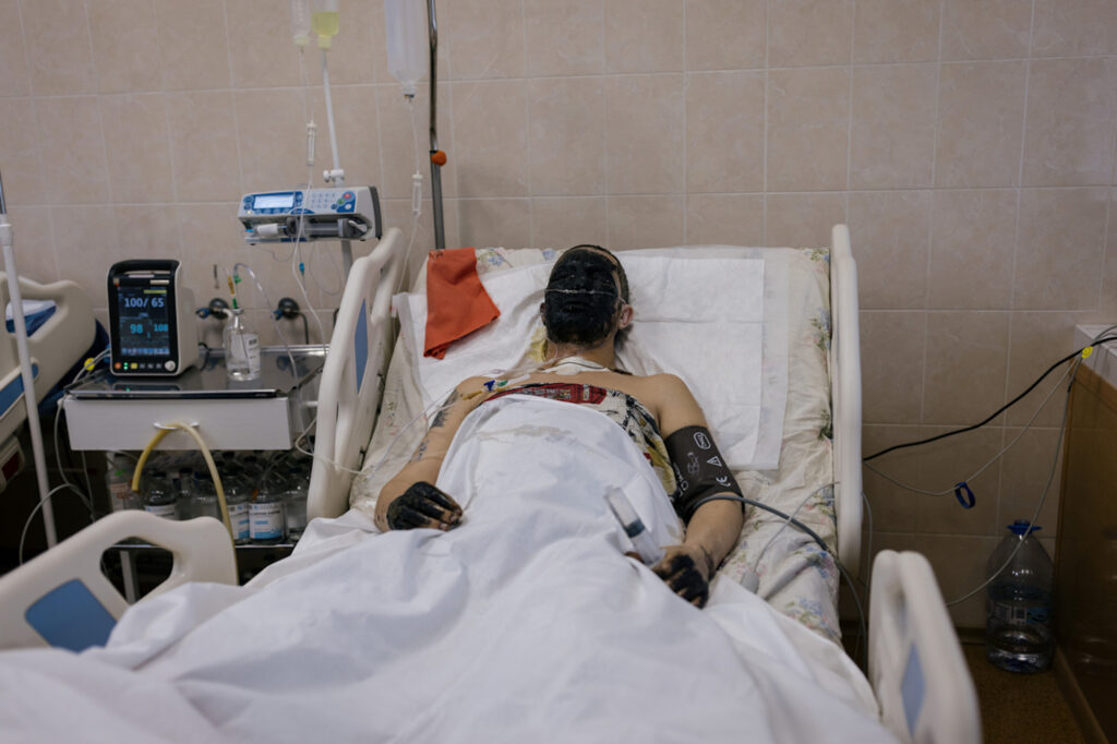 Ukraine, Dnipro, le 15 avril 2022. Hopital régional de Dnipro. Un soldat ukrainien brûlé au visage et aux mains, en soins intensifs.